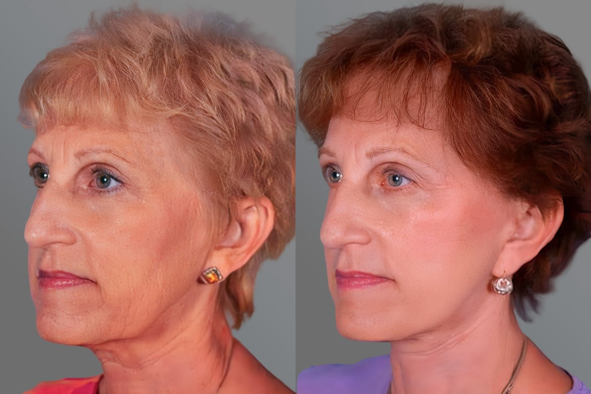 Facelift and Necklift Before and after photos in Sandy Springs, GA, Patient 16237