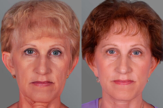 Facelift and Necklift Before and after photos in Sandy Springs, GA, Patient 16237