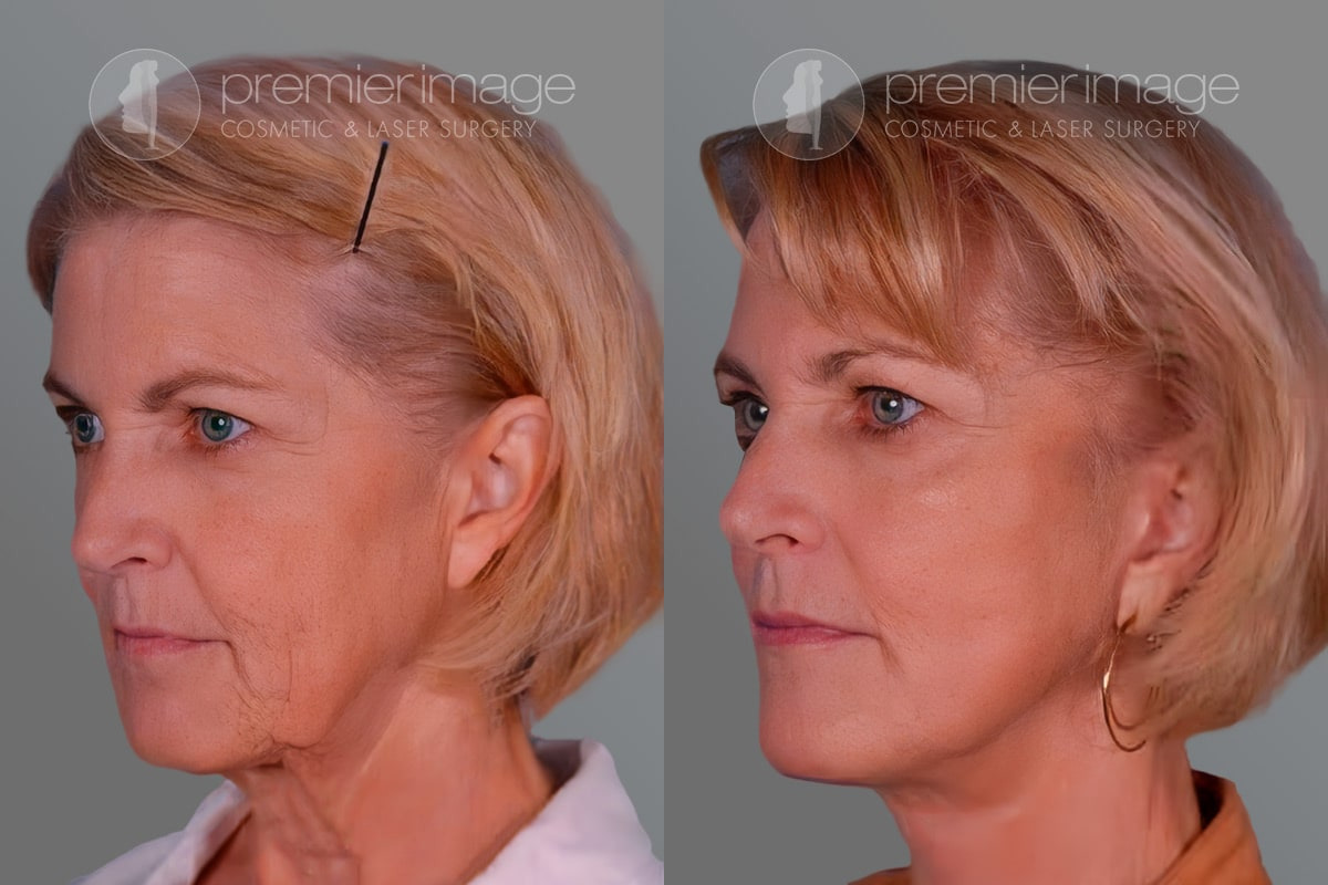 Facelift and Necklift Before and after photos in Sandy Springs, GA, Patient 16244