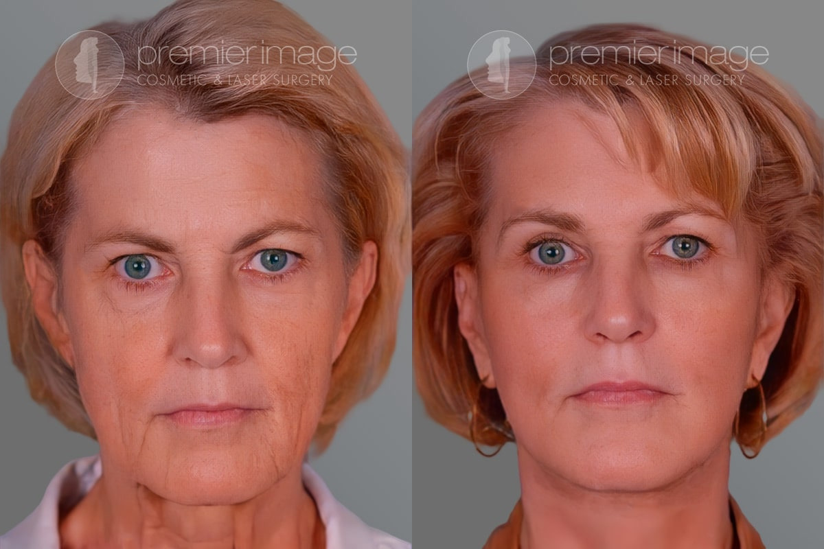 Facelift and Necklift Before and after photos in Sandy Springs, GA, Patient 16244