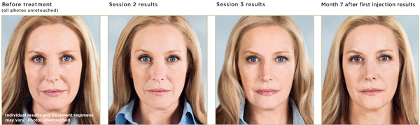 Sculptra Before-After Photos